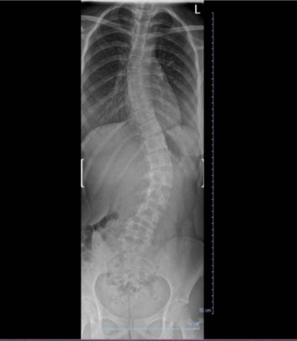 X-ray of Lacie's spine X-ray of Lacie's spine