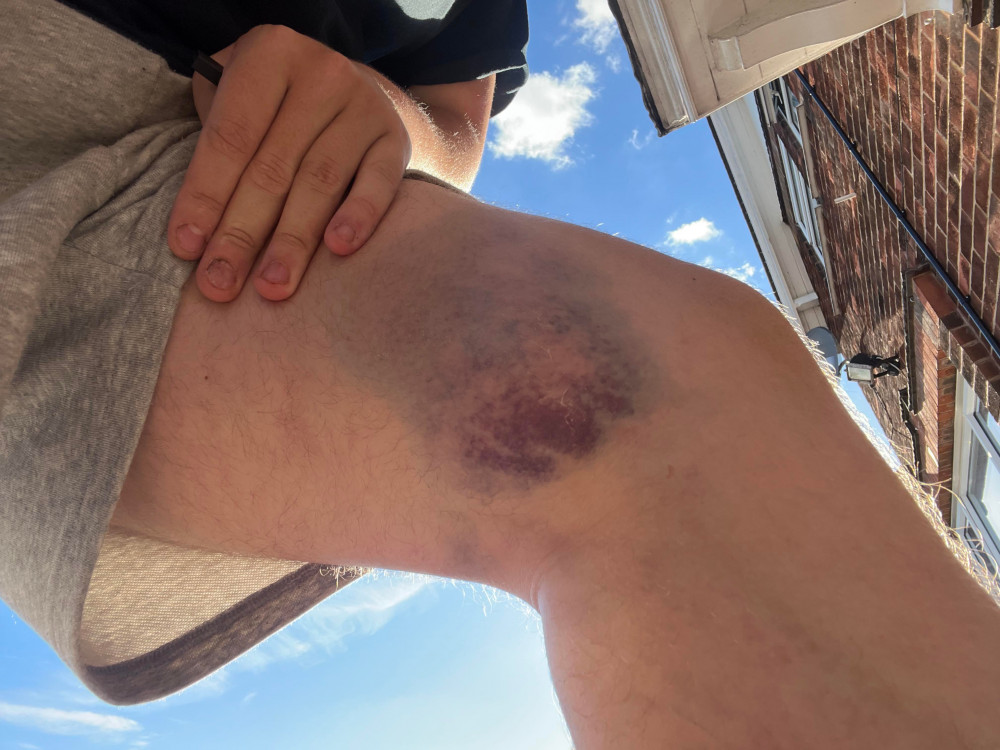 Max's leg was badly bruised after the incident. Photo: Max Hands