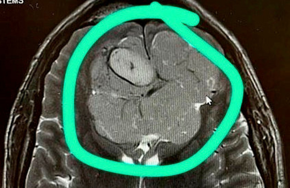 A tumour was found during a chance eye test. Image credit: SWNS. 