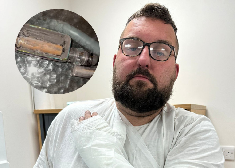 Mike Calver, from Stoke-on-Trent, suffered horrific injuries last month when his e-cigarette exploded in his hand (SWNS).