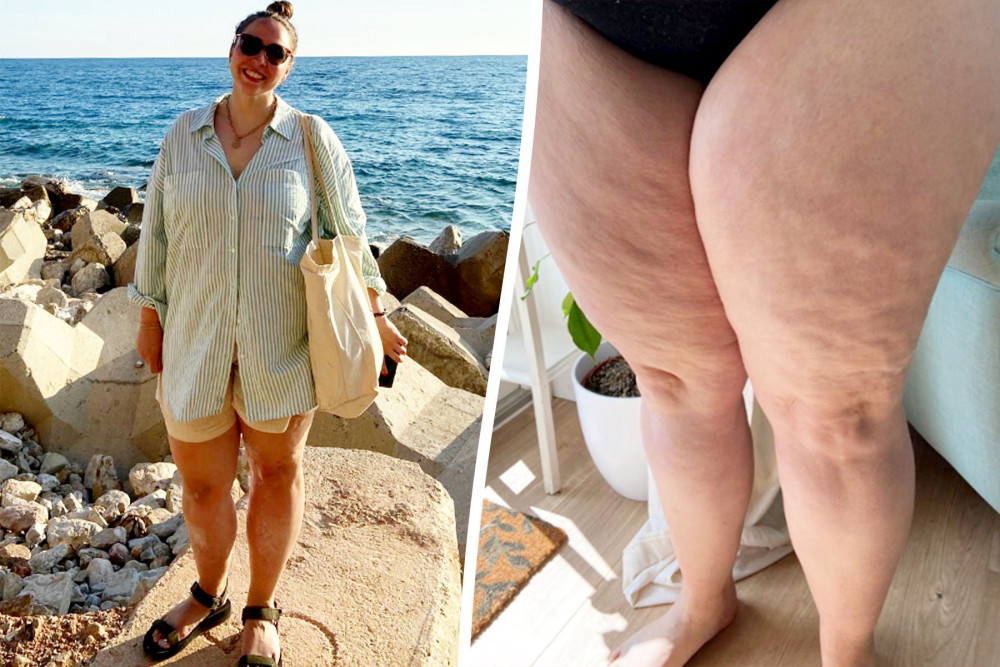 A woman from Stockport who was cruelly called 'thunder thighs' has regained confidence after embracing her rare condition (Images via SWNS)