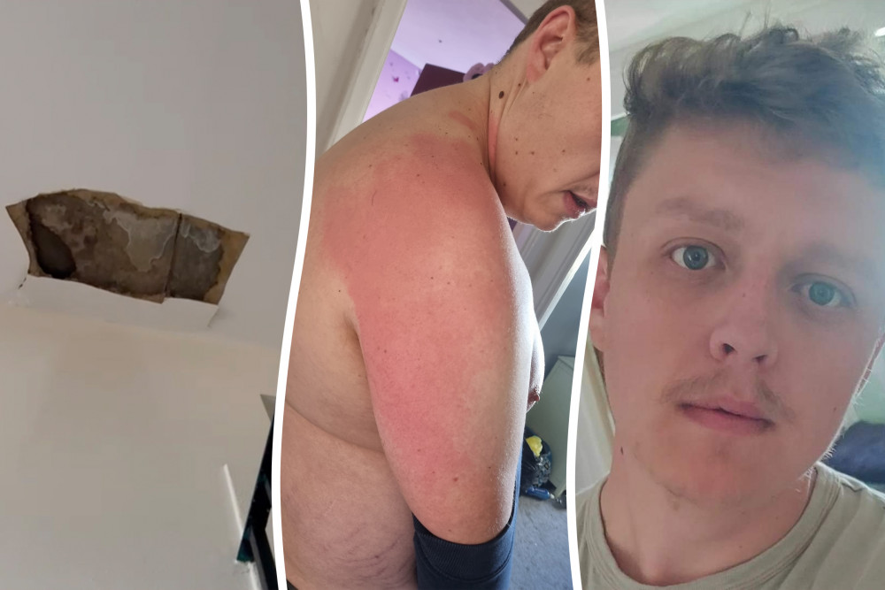 Kingston resident, Oliver Thompson, was left with second degree burns after a water tank burst, dropping boiling hot water onto him. (Credit: George Mathias / SWNS)