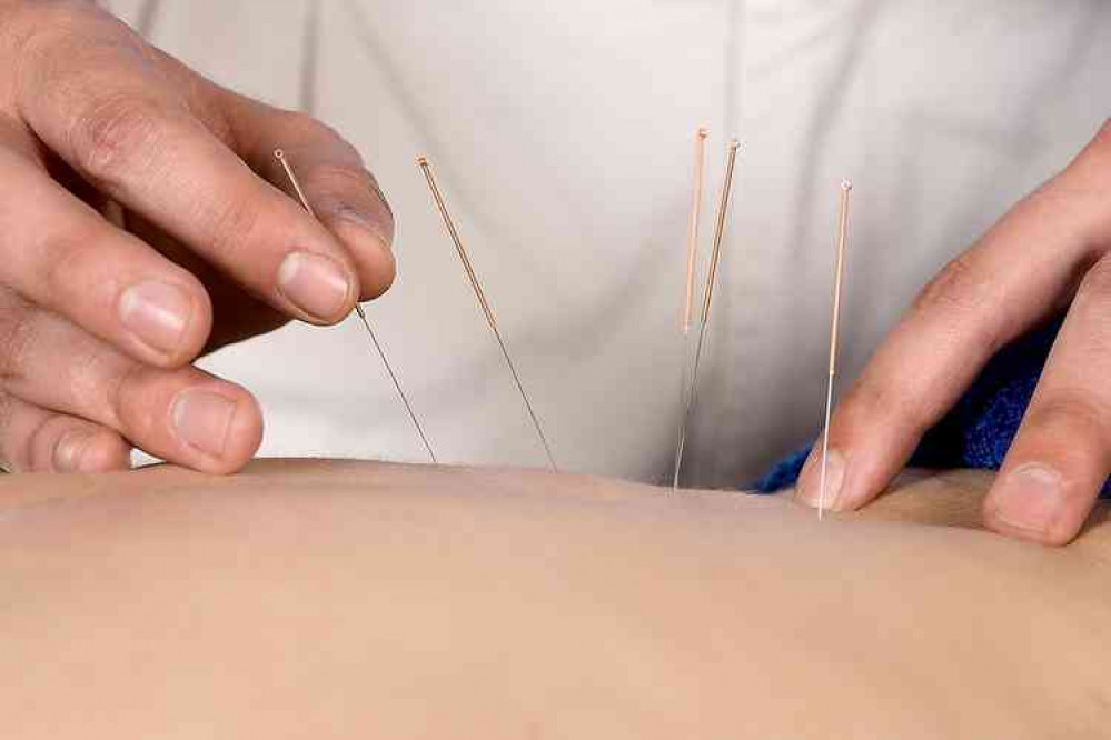 Dry needling is a modern version of Chinese acupuncture