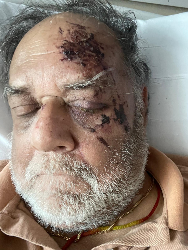 77-year-old Dr Anjam Bose after his fall. 