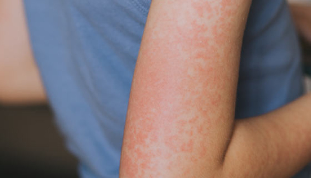 In Hertfordshire:  93.6% of children aged five have had one dose of vaccine