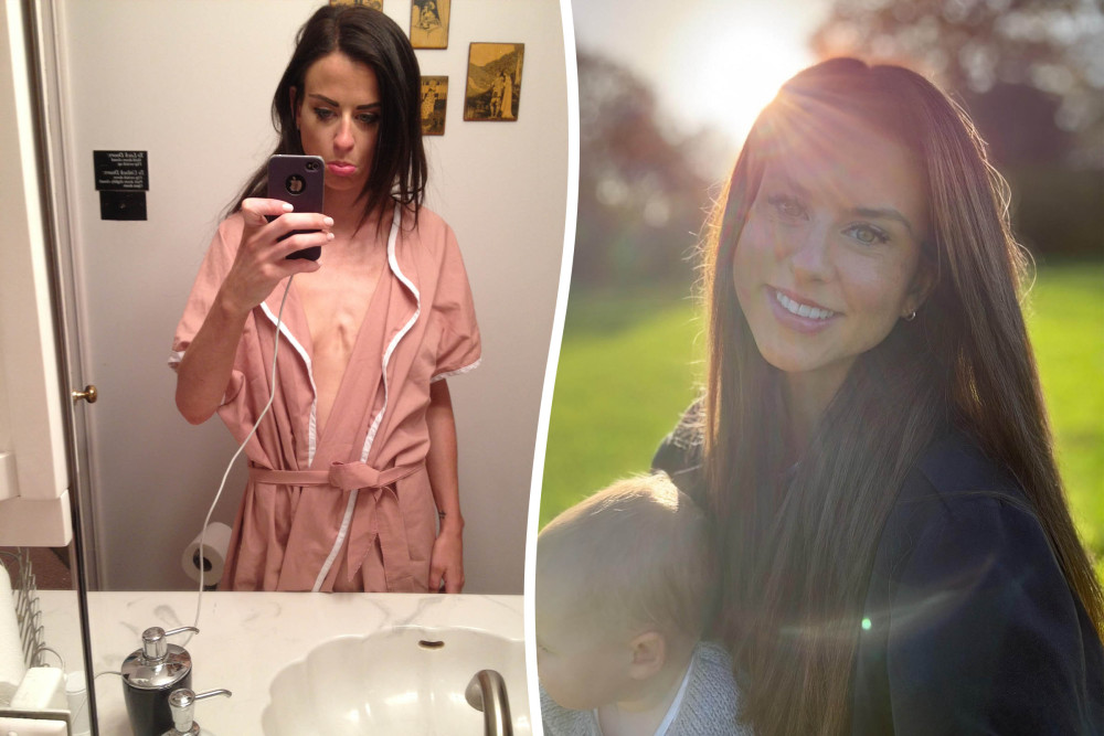 Helen Burke-Tennant from Richmond faced anorexia in her early 20s (credit: SWNS).